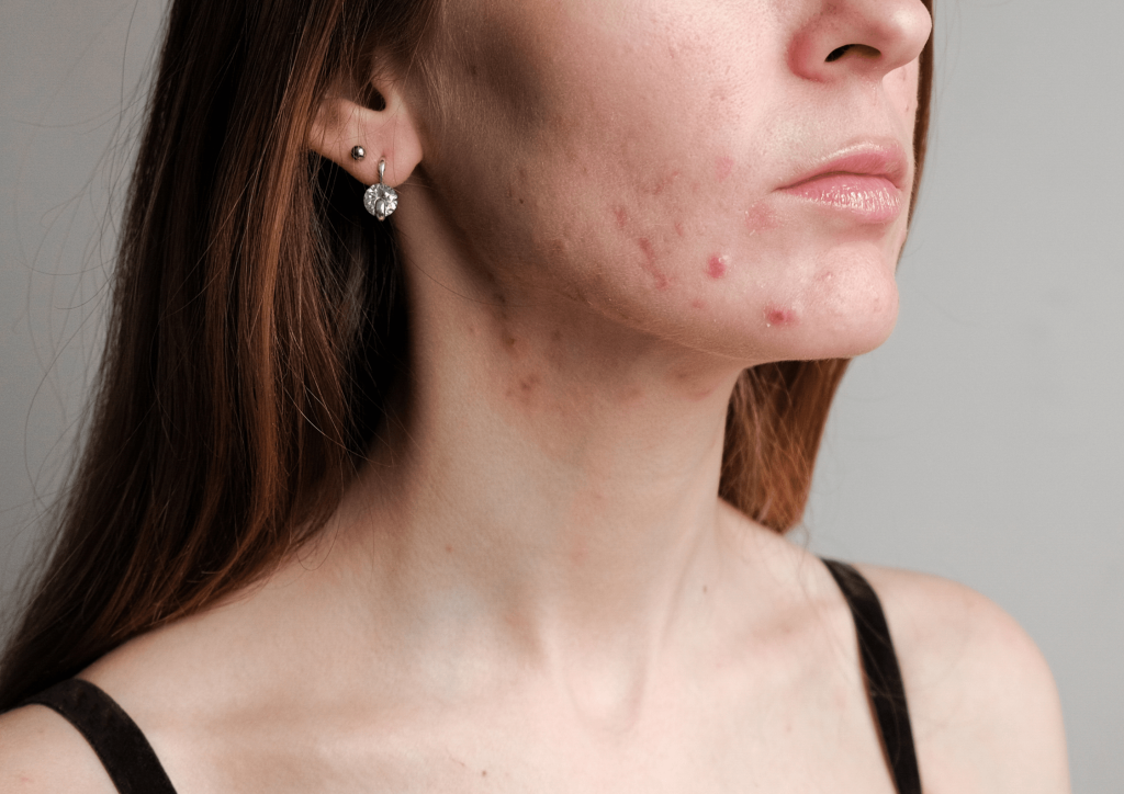 7 Powerful Reasons Microneedling in Dubai Will Transform Your Skin 2 Microneedling in Dubai on Acne