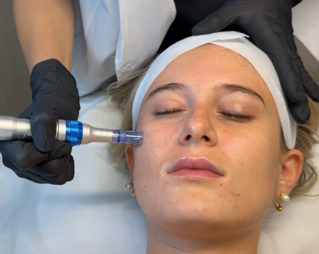 7 Powerful Reasons Microneedling in Dubai Will Transform Your Skin 1 microneedling in dubai treatment device on glowing skin